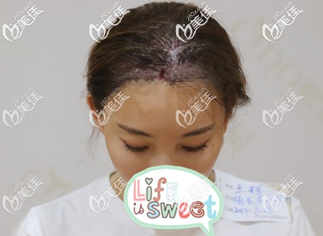 發(fā)際線種植術(shù)后即刻效果