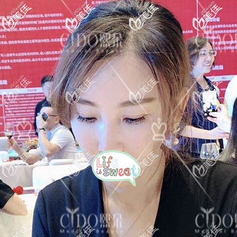 發(fā)際線種植1年效果圖