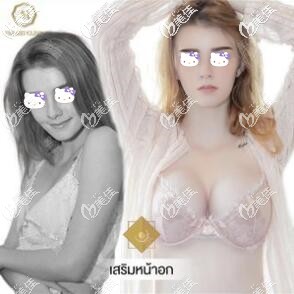 進(jìn)口假體隆胸術(shù)前術(shù)后對(duì)比照