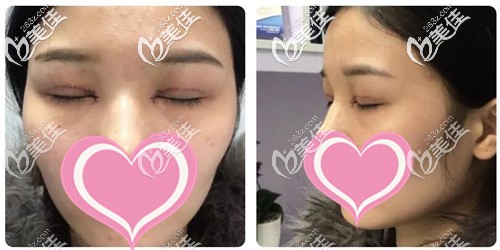 雙眼皮+開眼角手術后第三天恢復效果 雙眼皮+開眼角手術后第三天恢復效果