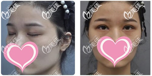 割完雙眼皮15天的照片 割完雙眼皮15天的照片