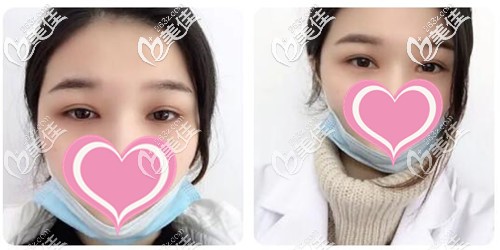 雙眼皮手術后1個月恢復圖 雙眼皮手術后1個月恢復圖