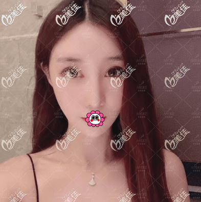 北京熱瑪吉醫(yī)院哪家好?我花2萬(wàn)多找北京美萊劉崇醫(yī)生做第四代熱瑪吉效果滿意