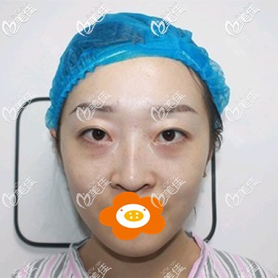 祛眼袋手術(shù)前我的照片 祛眼袋手術(shù)前我的照片