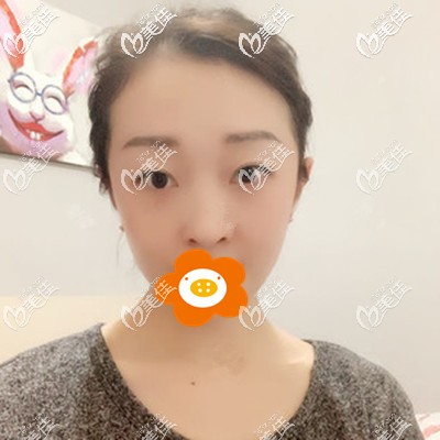 內(nèi)切祛眼袋術(shù)后半個(gè)月效果 內(nèi)切祛眼袋術(shù)后半個(gè)月效果