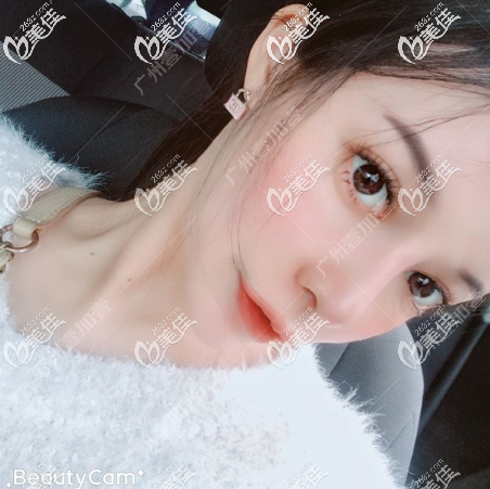 廣州壹加壹李明做鼻子怎么樣 廣州壹加壹李明做鼻子怎么樣