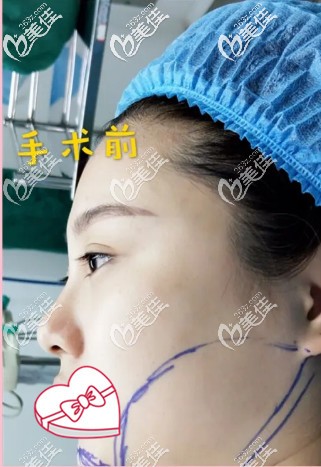 陳譽華院長為我做術前設計 陳譽華院長為我做術前設計