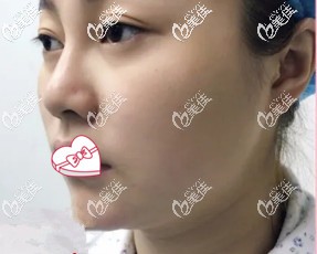 做光纖溶脂瘦臉5天后臉變大 做光纖溶脂瘦臉5天后臉變大