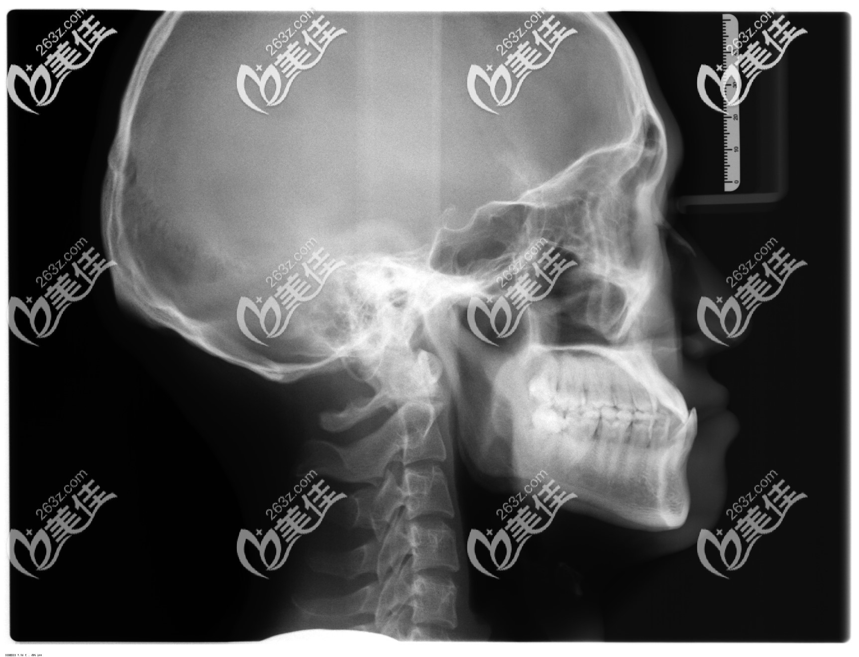 骨性地包天矯正前拍的口腔頭顱側(cè)位片