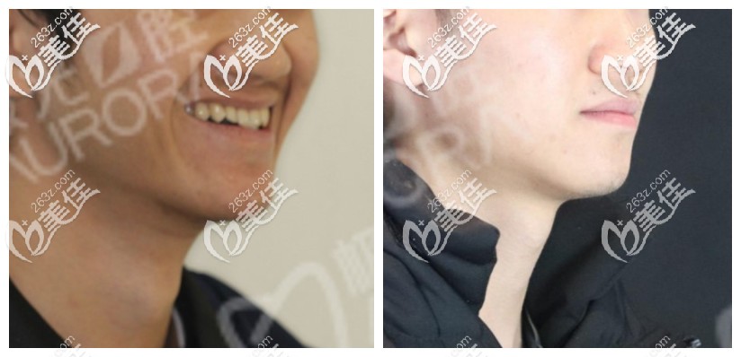 23歲骨性地包天帶牙套好了，我真的只找成都極光口腔醫(yī)生游學(xué)敏矯正了牙齒沒做正頜手術(shù)