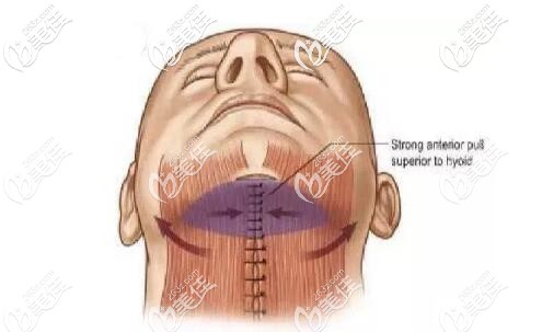 頸闊肌成形術(shù)原理