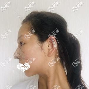 剛做完自體軟骨隆鼻術(shù)后鼻子腫脹