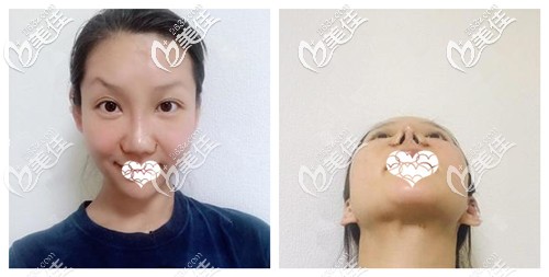 鼻綜合術(shù)后10天鼻子拆線