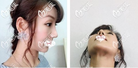 綜合鼻整形術(shù)后鼻子微腫