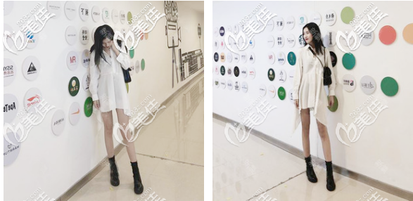 大腿太粗抽脂親身經(jīng)歷:我的大腿吸脂是花1萬多元找佛山華美梁宗建做的,性價(jià)比很高