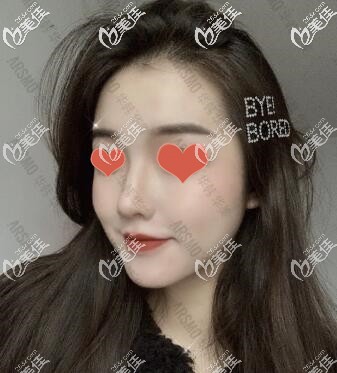 別再問長沙華韓華美孫玥玥做鼻子怎么樣了，看完我的真實隆鼻案例效果你就知道了！