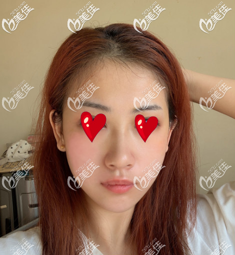 西安米蘭柏羽自體脂肪填充面部術(shù)后第十五天