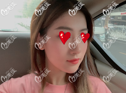 西安米蘭柏羽自體脂肪填充面部術(shù)后第20天