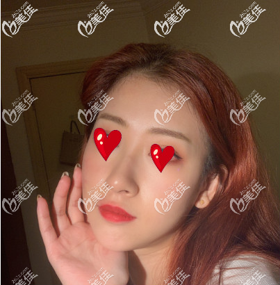 西安米蘭柏羽自體脂肪填充面部術(shù)后30天