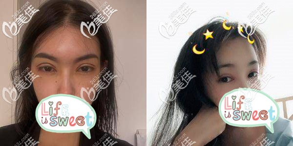 切開雙眼皮術(shù)后5天，腫到懷疑人生