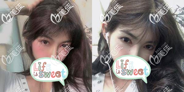 成都東籬醫(yī)院徐墩全切雙眼皮1個月效果圖