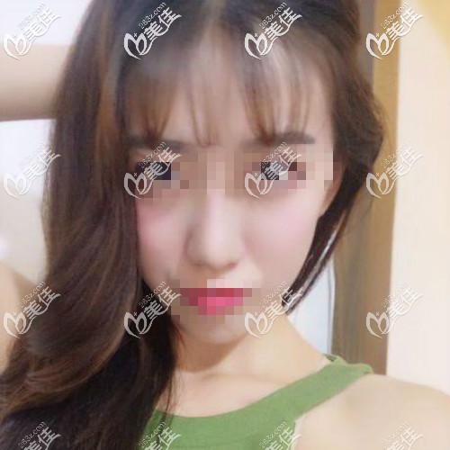 自體肋骨鼻兩個月