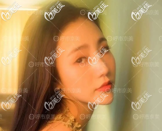 我整鼻子經(jīng)歷證明:耳軟骨隆鼻半年基本沒(méi)了、耳軟骨墊鼻尖鼻頭肥厚鼻子硬,不是每個(gè)人都有哦！