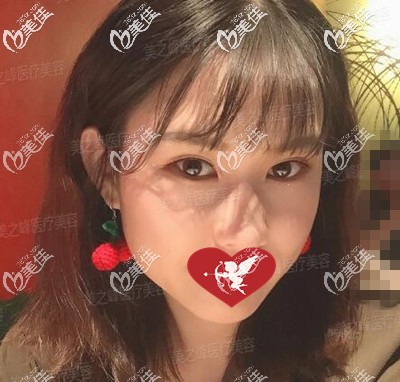 真的是被長沙美之峰劉磊給我做的雙眼皮+開眼角眼綜合效果給驚訝到了，大家看下覺得怎么樣？