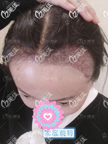 發(fā)際線種植后即可效果圖 發(fā)際線種植后即可效果圖