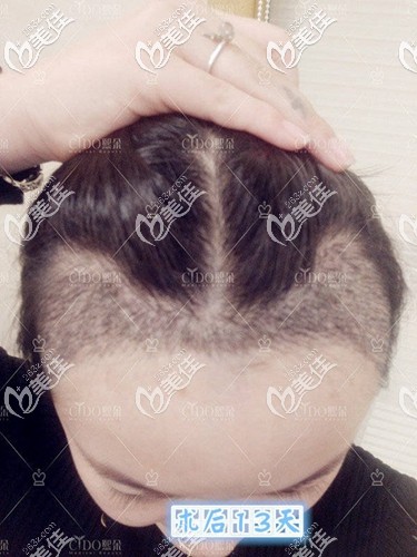 植發(fā)際線術(shù)后13天照片 植發(fā)際線術(shù)后13天照片
