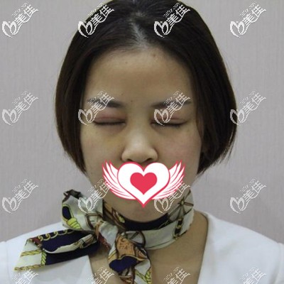 雙眼皮術(shù)后一周拆線