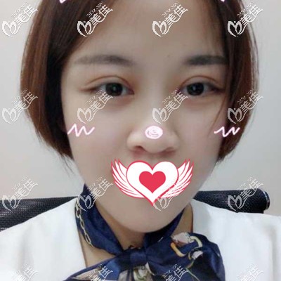 術(shù)后一個(gè)月效果分享