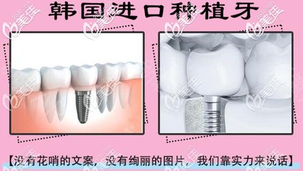 成都君臣口腔種植牙怎么樣