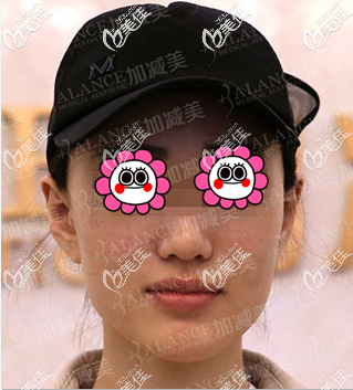 做下頜角整形前 做下頜角整形前