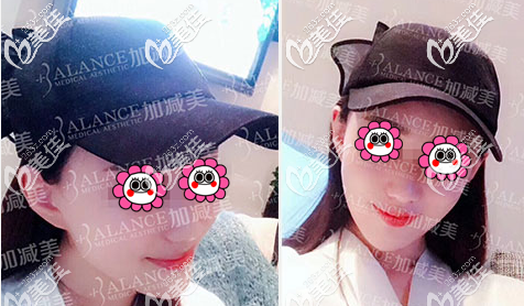 黃寅守醫(yī)生給我做下頜角整形手術(shù)有半個(gè)月了 黃寅守醫(yī)生給我做下頜角整形手術(shù)有半個(gè)月了