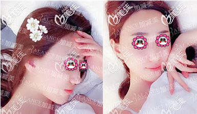 我做V美長(zhǎng)弧線下頜角整形手術(shù)30天樣子 我做V美長(zhǎng)弧線下頜角整形手術(shù)30天樣子