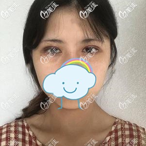 眼綜合術(shù)后7天線條流暢 眼綜合術(shù)后7天線條流暢