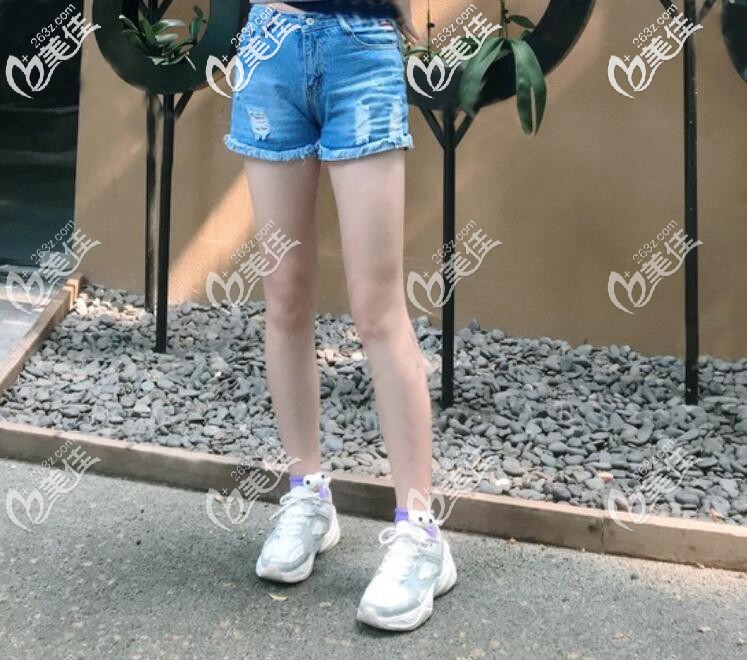 從我在寧波靜港找祝海新做的吸脂瘦大腿親身經(jīng)歷來看沒有出現(xiàn)凹凸不平的現(xiàn)象