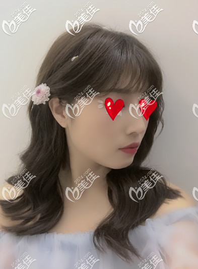 我還是比較有資格告訴你青島哪家醫(yī)院做假體隆鼻好的，畢竟我都做了半年了