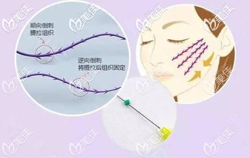 埋線提升手術 埋線提升手術