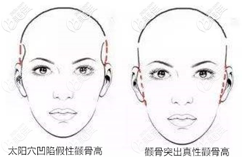 顴骨高和太陽穴凹陷的區(qū)別