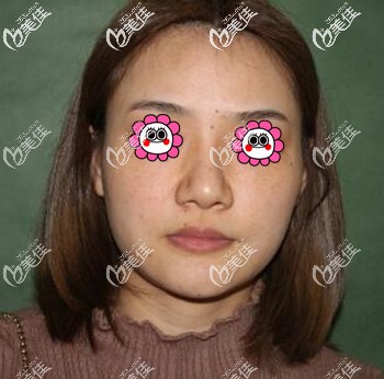 埋線提升術前照 埋線提升術前照