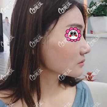 埋線提升面部術后當天 埋線提升面部術后當天