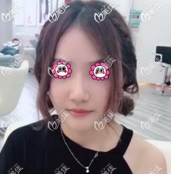 面部埋線提升術后半個月的恢復效果照 面部埋線提升術后半個月的恢復效果照