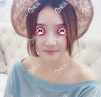 真實經(jīng)歷：找長沙希美醫(yī)療美容做面部埋線提升2個月了，給大家看下恢復(fù)效果怎么樣？