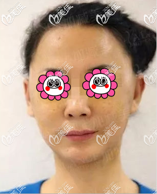 我做V美減齡V9再生青春術一周了