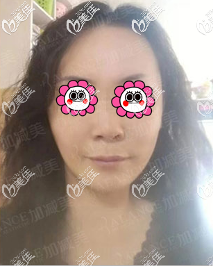 v美減齡V9面部提升半個月樣子