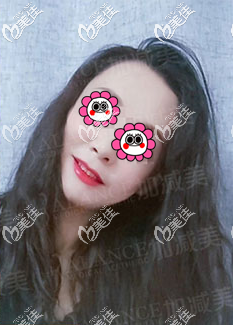 黃寅守面部提升手術怎么樣?我做v美減齡V9提升效果參考