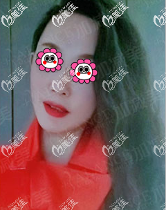 沒想到北京加減美黃寅守不僅磨顴骨技術口碑好而且做V美減齡V9面部提升也不錯