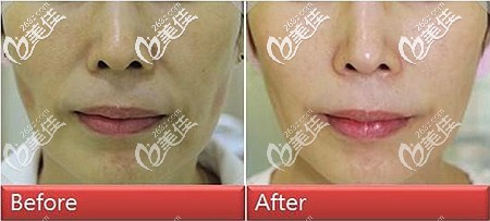 面部埋線提升后的對(duì)比